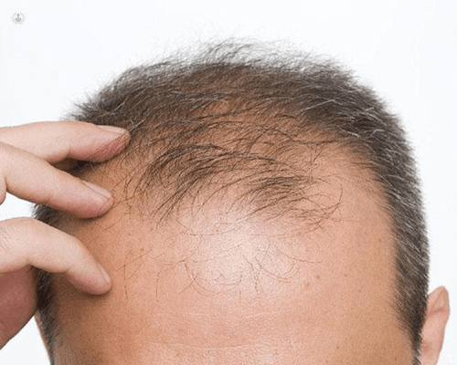 Alopecia o caída del cabello